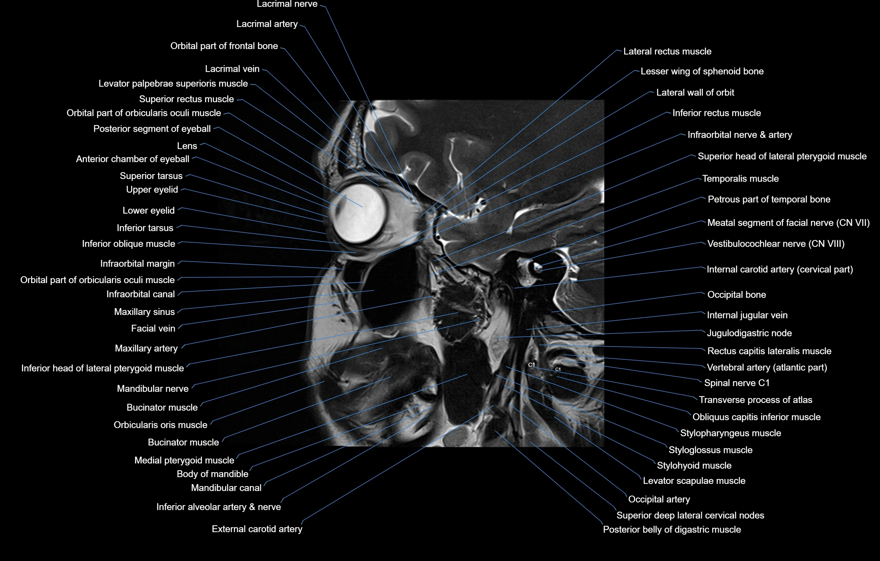 paranasal sinuses(PNS) MRI coronal  cross sectional anatomy 3T radiology  image-img-00001-00013.webp